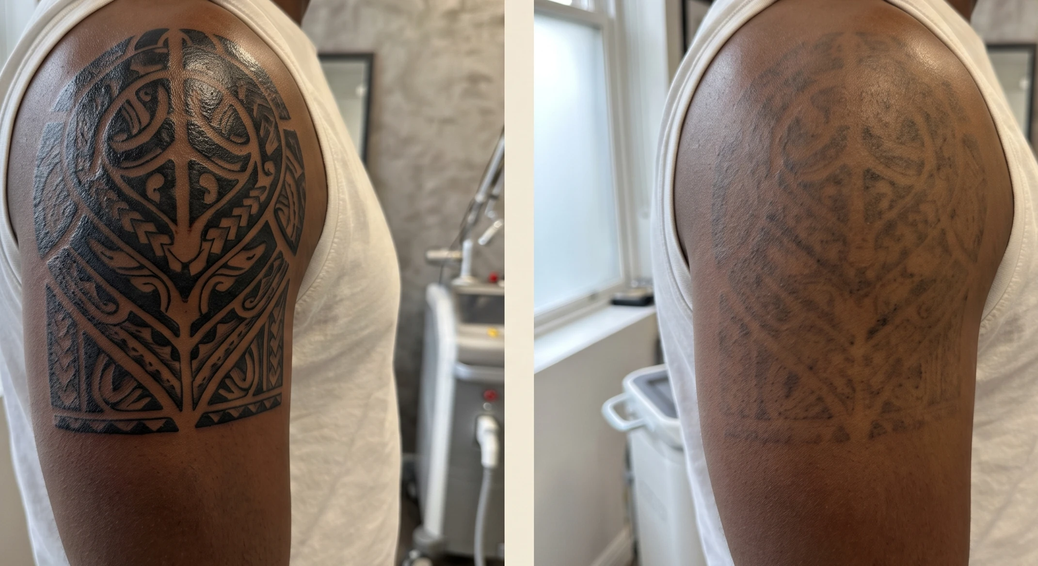 Illustrative before-and-after of laser tattoo removal on a forearm.