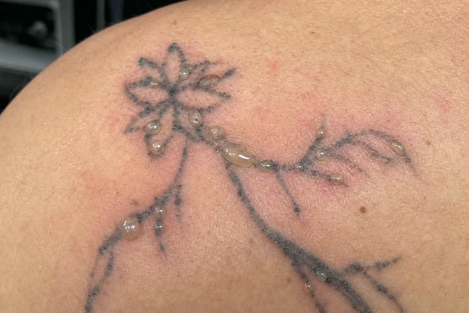 A freshly treated tattoo — blisters can form over the next day or two