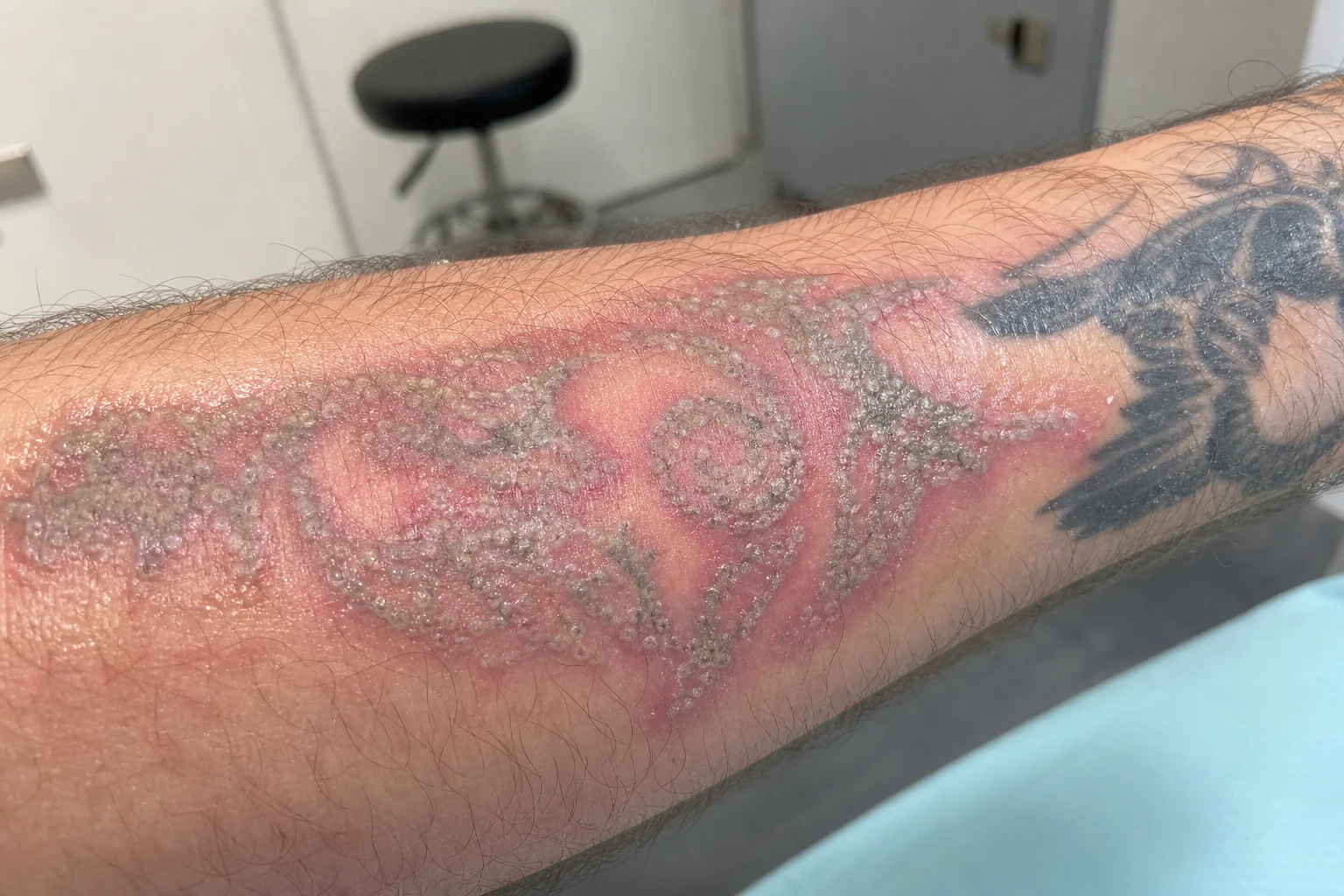 Post-laser redness and swelling in the days after a session