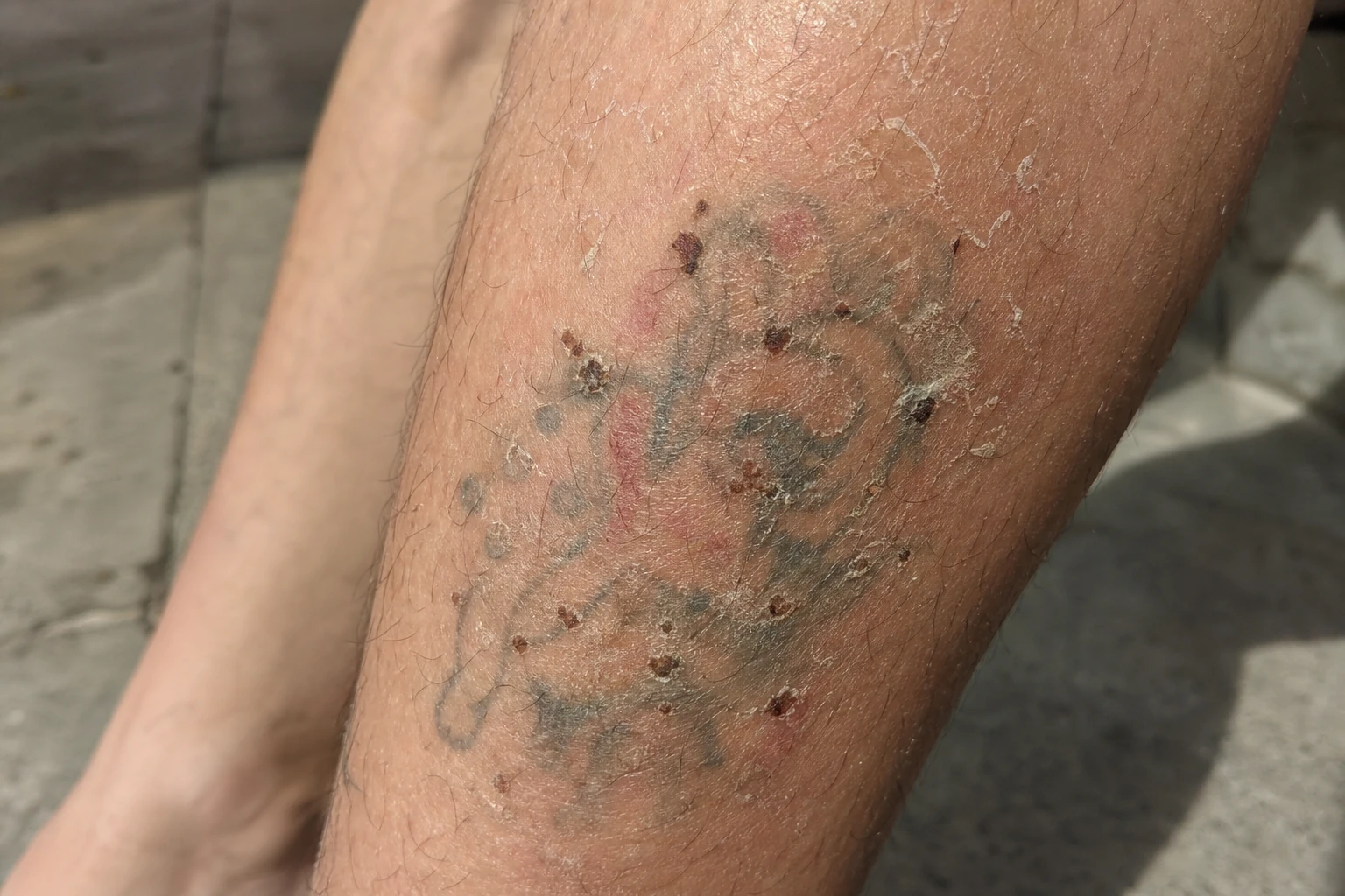 Scabbing and flaking as the treated skin heals