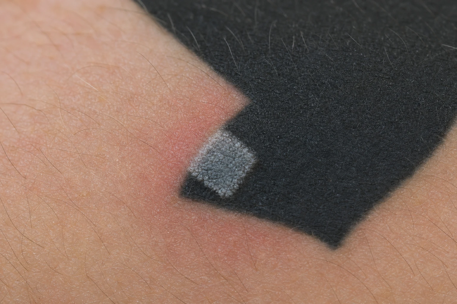 A forearm tattoo during removal