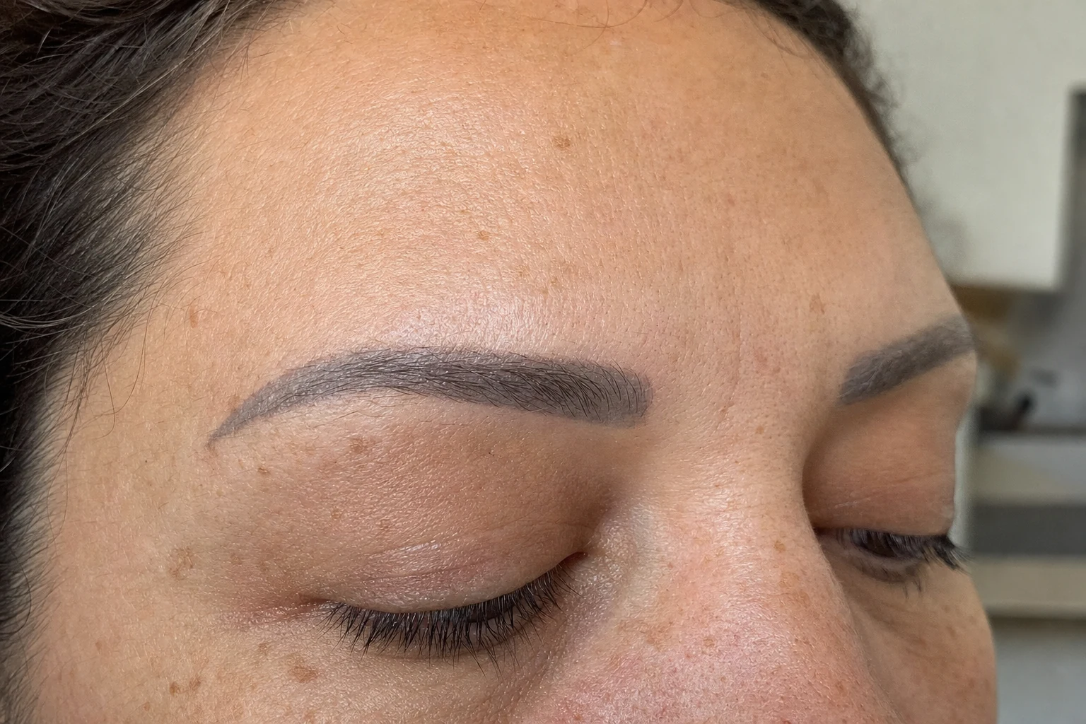 Cosmetic brow tattoos are a common saline-removal case