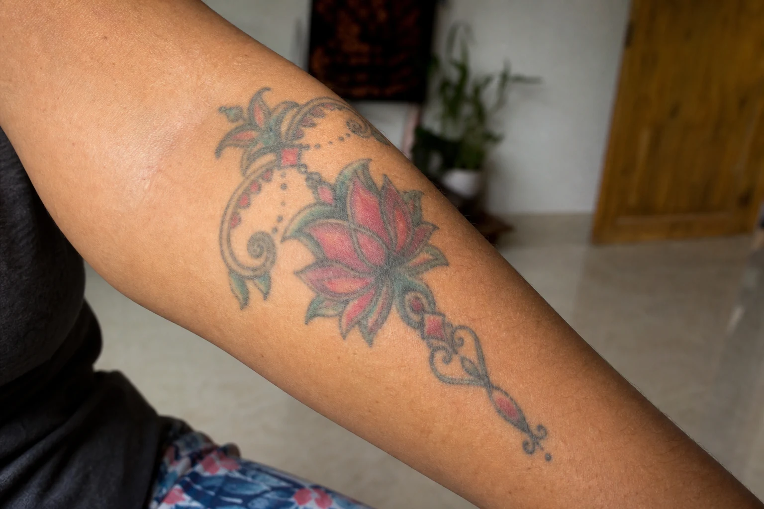 A forearm tattoo during removal