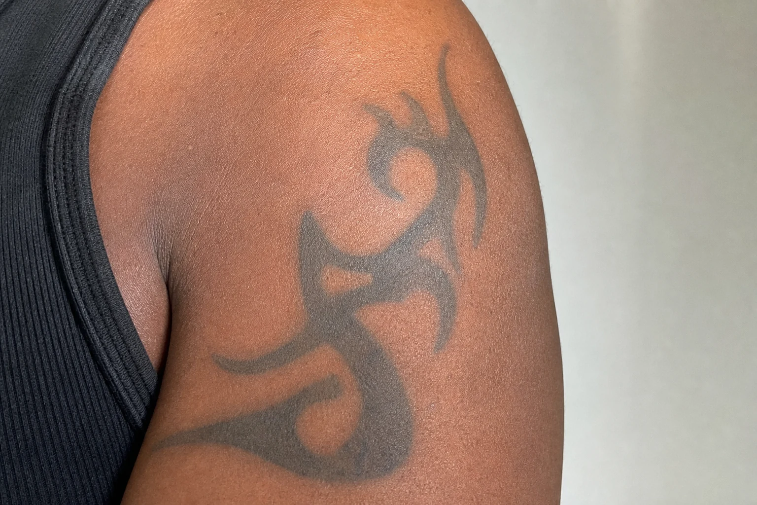 Darker skin is treated at 1064nm to protect its pigment