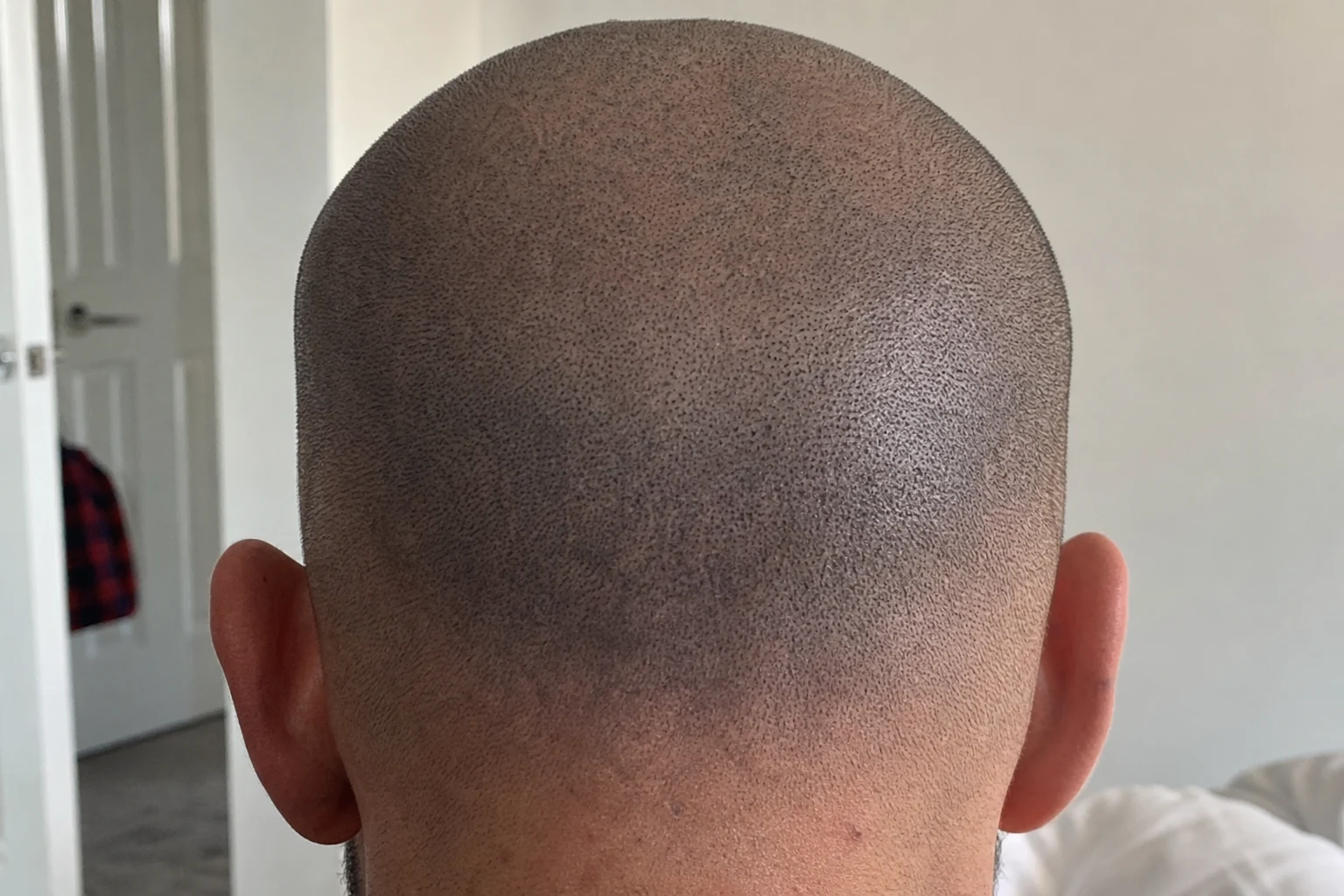 A tattoo undergoing laser removal