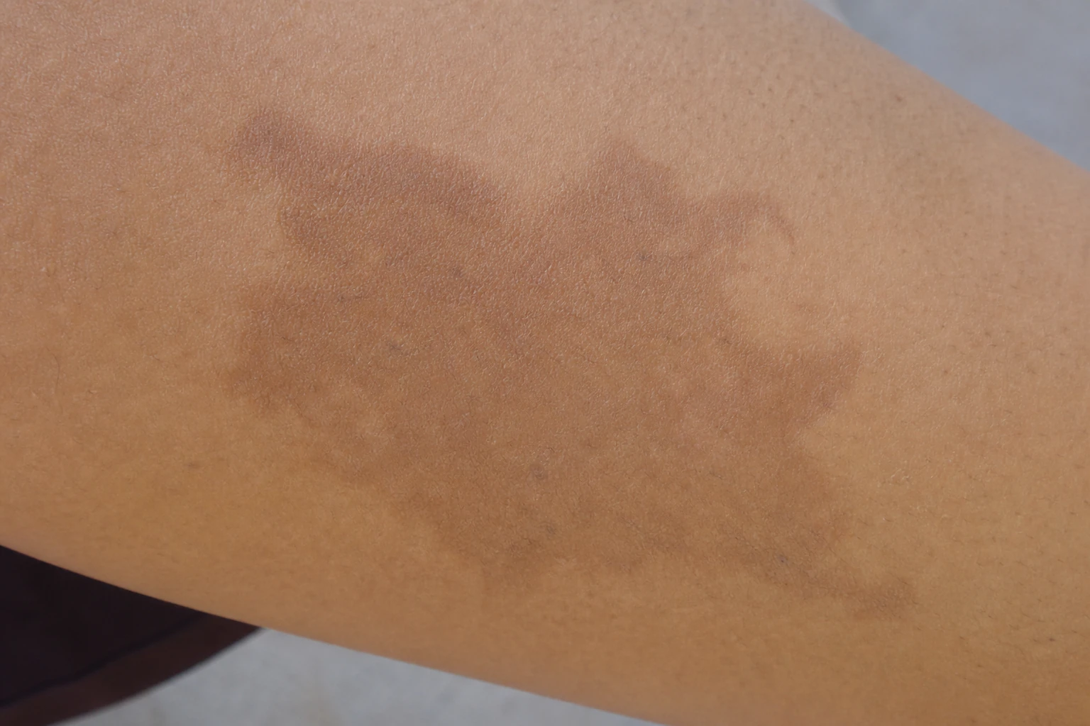 Hyperpigmentation — a darker patch where a tattoo was treated