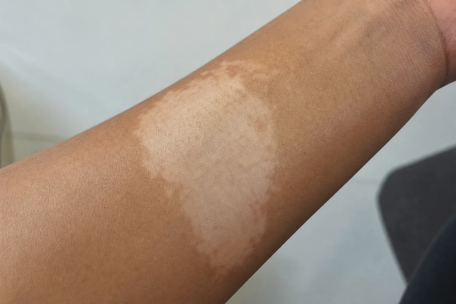 Hypopigmentation — a lighter patch where the skin lost pigment after treatment