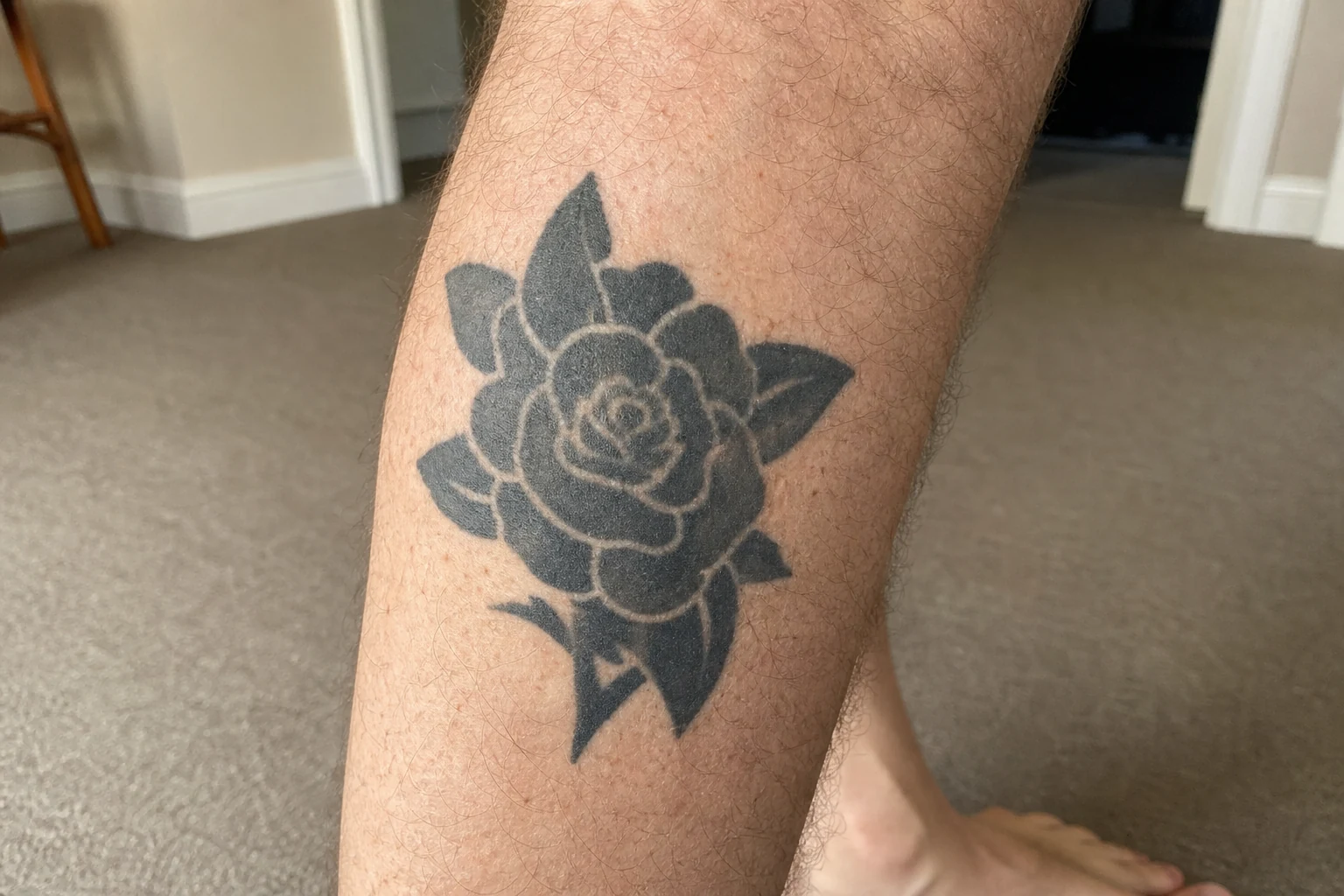 Darker skin is treated at 1064nm to protect its pigment