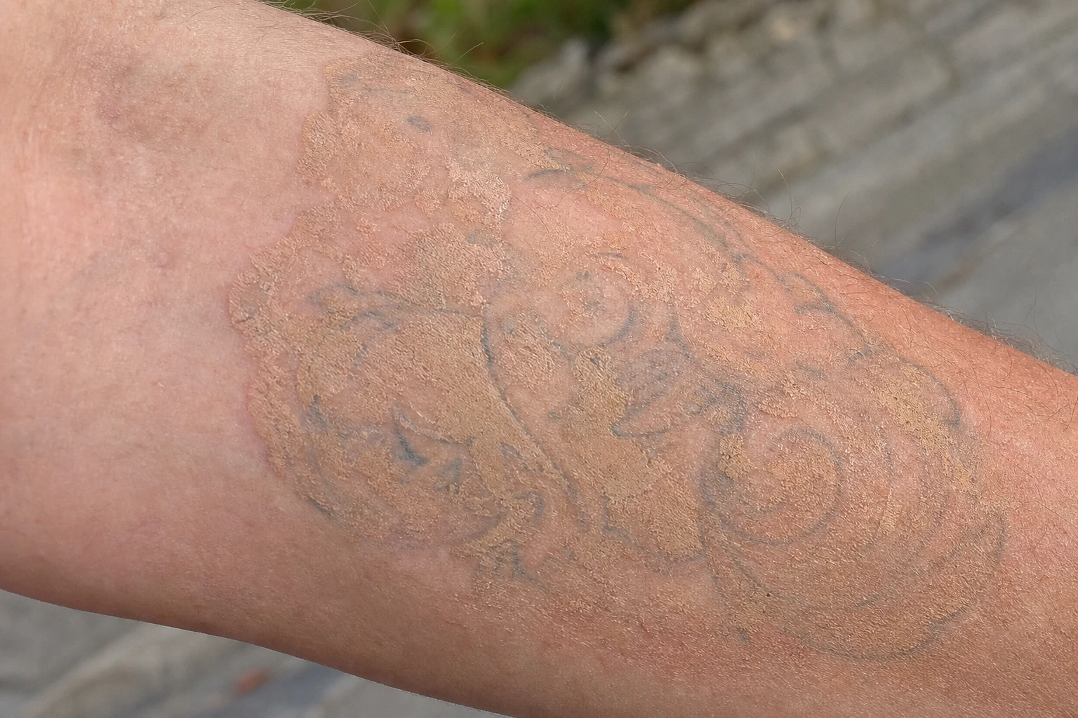 Flesh-toned ink is tattooed over old work to disguise it — patchy and hard to remove cleanly