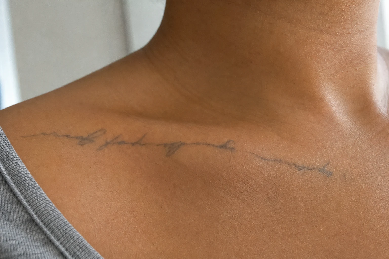 A tattoo undergoing laser removal