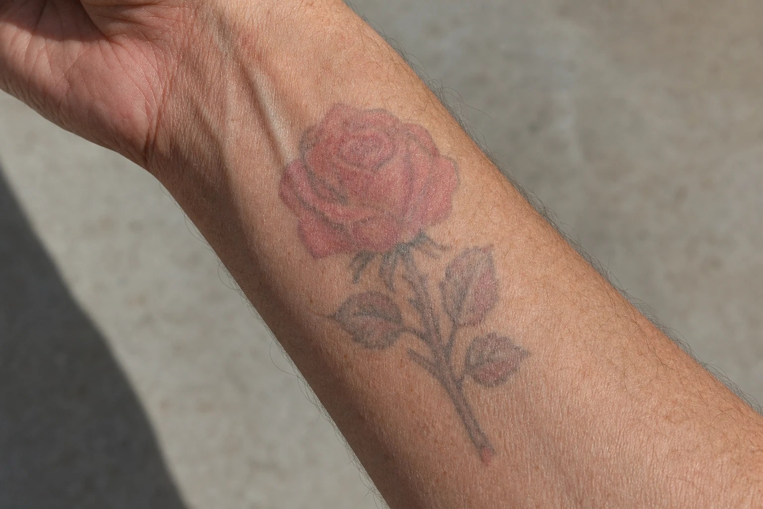 A red-ink tattoo, treated at 532nm