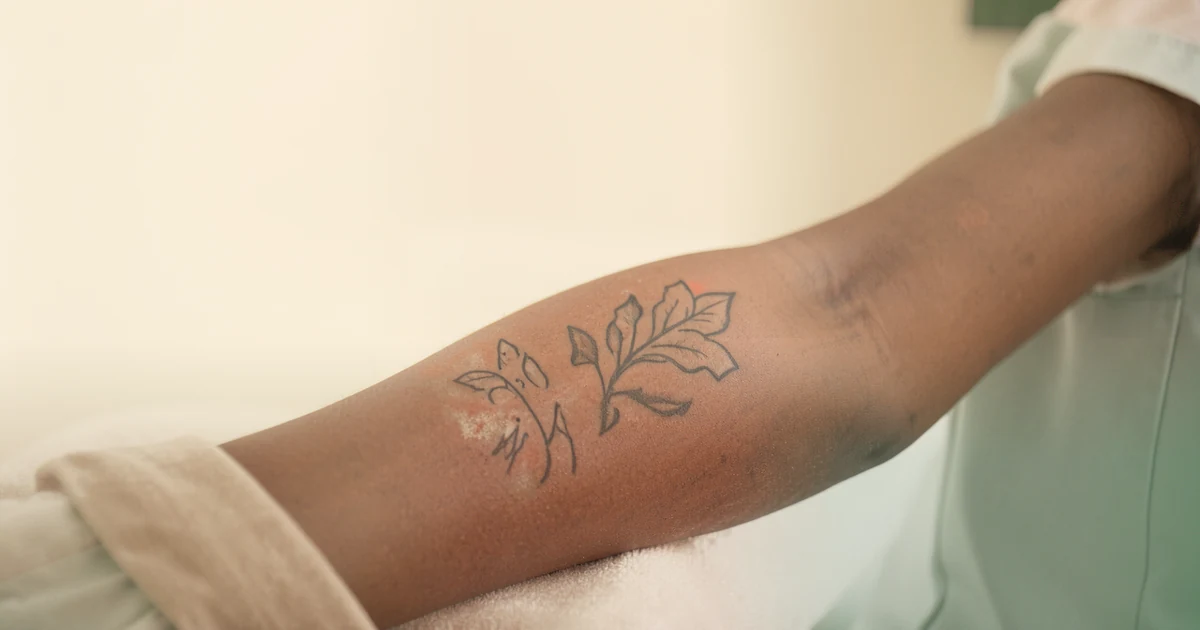 Tattoo Removal on Dark Skin: The Laser & Wavelength That Matter — an independent, data-backed guide from Tattoo Removal Guide