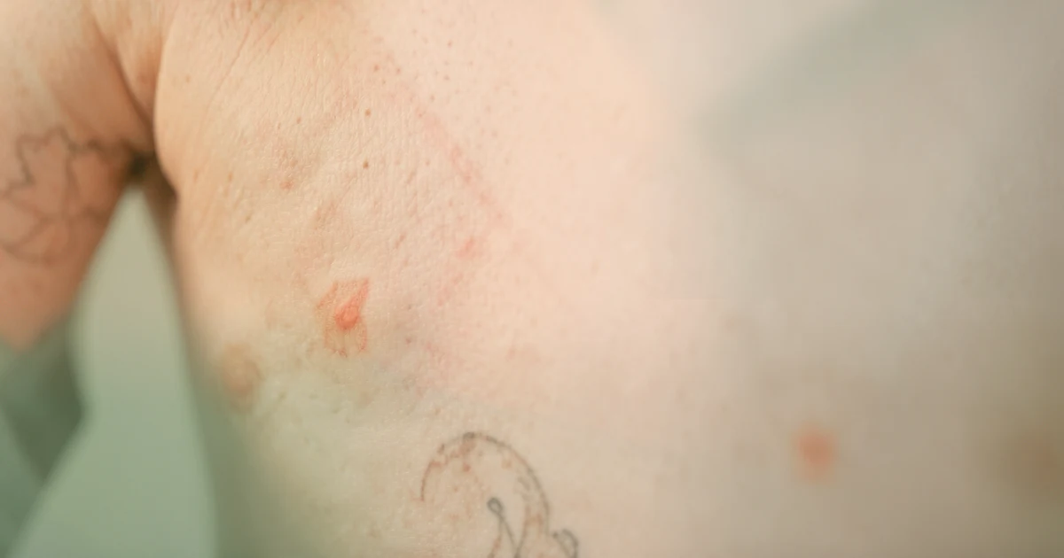 Tattoo Removal With Keloid-Prone Skin: Can You Still Do It Safely? — an independent, data-backed guide from Tattoo Removal Guide